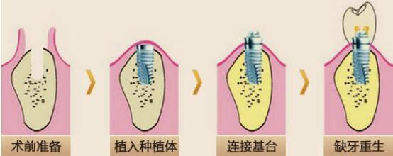 如何种植牙齿种植牙过程是怎样的