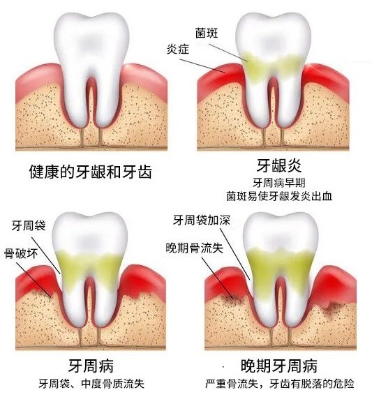 深圳牙周炎治療費用