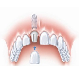 韩国Dentium种植