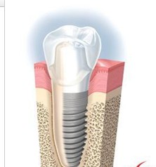 种植牙的优点