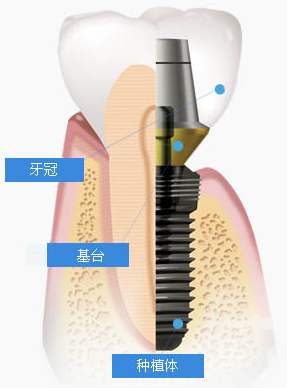 种植牙的注意事项