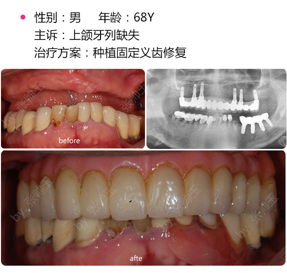 种植后牙选择什么材料好