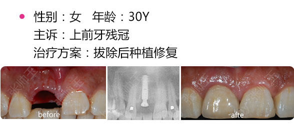 拔牙后可以马上种牙吗？