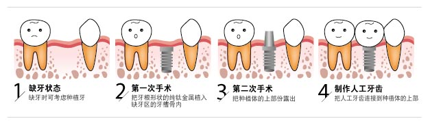 种植牙人人合适吗？