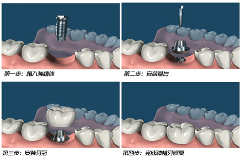 缺牙后何时种牙比较好？