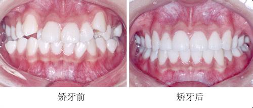 深圳牙齿矫正需要多长时间？