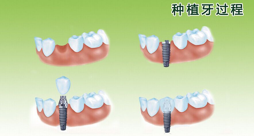 种植牙要避免这些误区