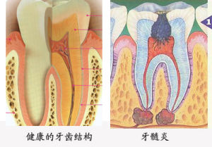 导致急性牙髓炎的原因有哪些？