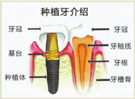 种植体脱落怎么办？