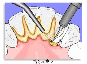 洗牙前要注意哪些事项？