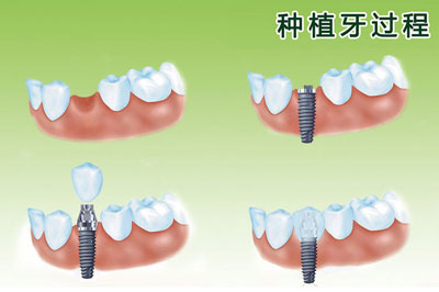 做种植牙需要满足哪些条件？