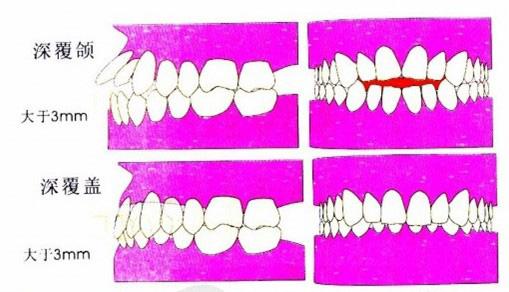 什么是前牙深覆盖？