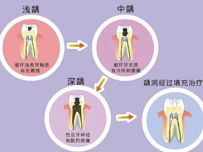 如何知道自己有没有虫牙？