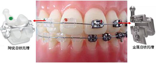 4种牙齿矫正方法对比