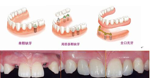 哪些情况下做种植牙比较合适？