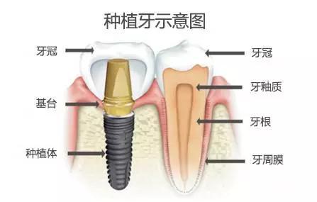 种植牙选什么种植系统比较好？