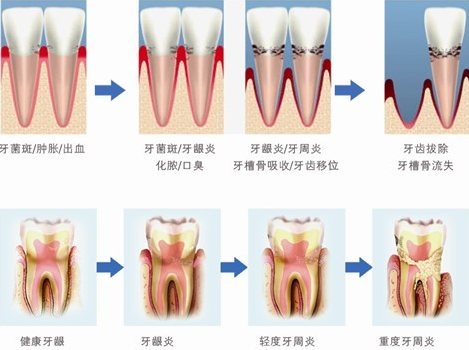 哪些牙周病可以通过洗牙来预防？