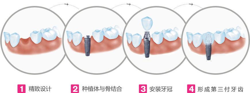 种植牙价格差别大应该怎么选？