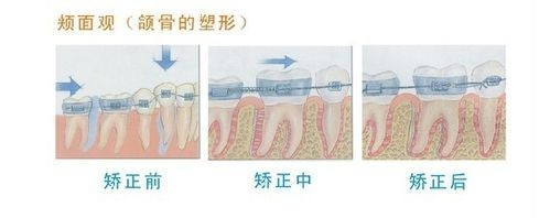 牙齿矫正的原理是什么？