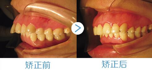 深圳龅牙矫正方法