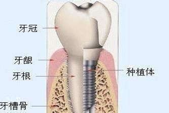 深圳种植牙危害有哪些？