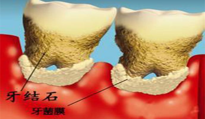 深圳牙结石形成原因有哪些？