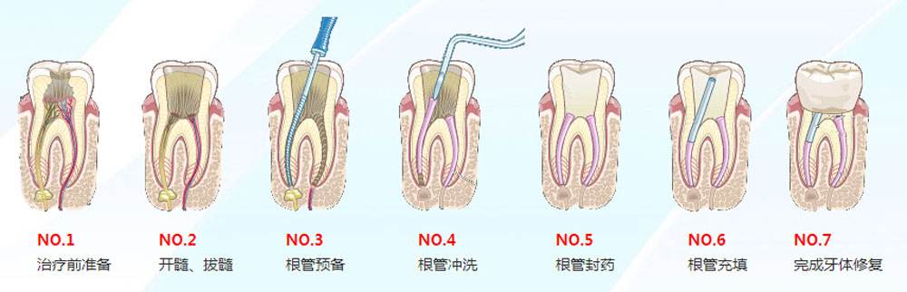 深圳牙髓炎根管治疗步骤