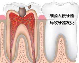 深圳牙髓炎治疗方法