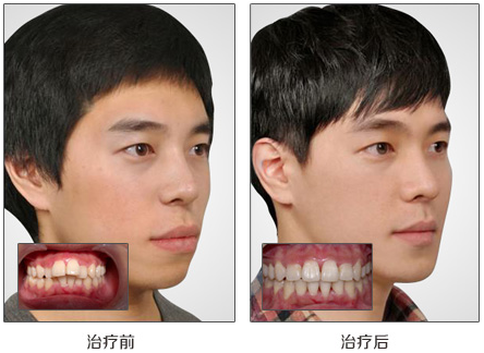 深圳轻微龅牙可以矫正吗？