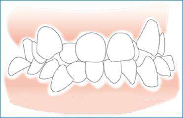 深圳牙齿拥挤危害有哪些？
