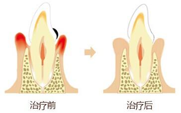 深圳牙周炎治疗怎么做？