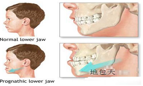 深圳儿童地包天如何治疗？