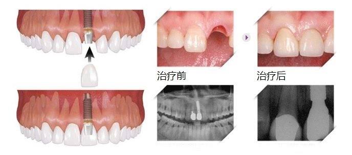 种一颗牙大概多少钱？