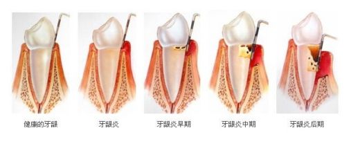 重度牙龈炎洗牙要多少钱？